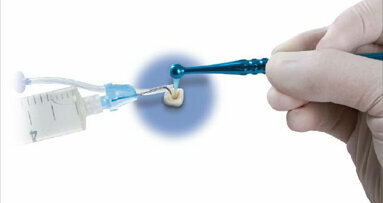 EndoVac system – nová dimenze výplachů v endodoncii