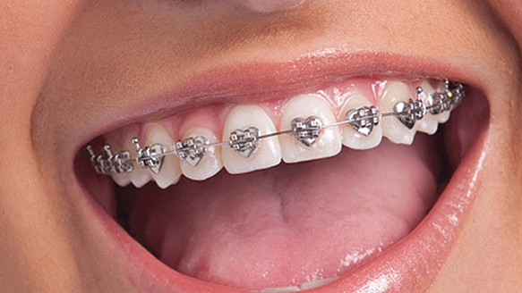Ortodoncja bez tajemnic – prawdy i mity na temat prostowania zębów