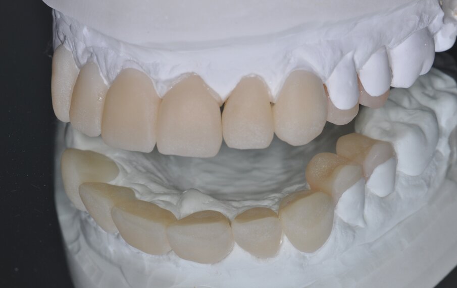 Fig. 10: Milled restorations fit on the model