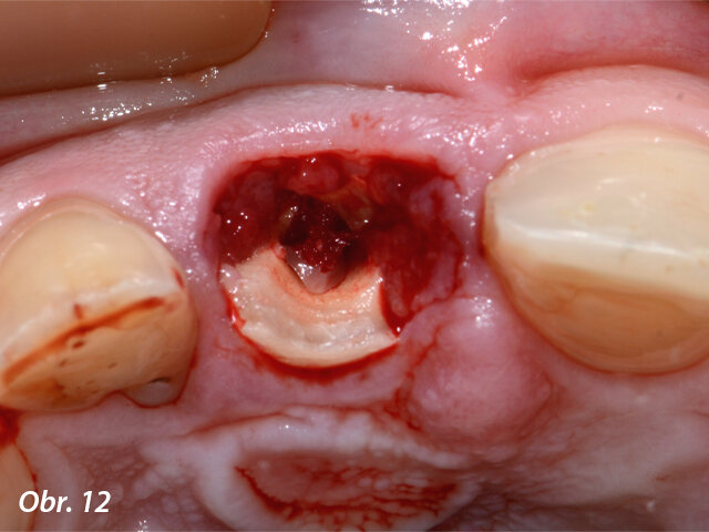 Viditelná granulační tkáň v místě resorpce a fraktury zubu 11.