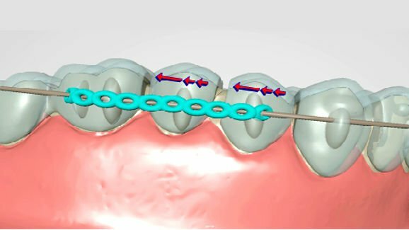 The new NimrodAligner: From straightforward to complex cases