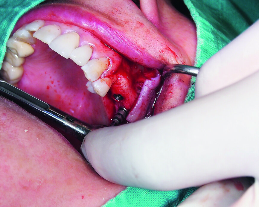 Fig. 8: Placement of a GC Aadva Standard 4.0 x 10.0 mm implant in the molar region.