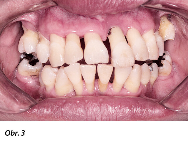 Selhávající chrup v horní i dolní čelisti s viklavostí, špatnou okluzí, posunutými zuby a ztrátou kosti