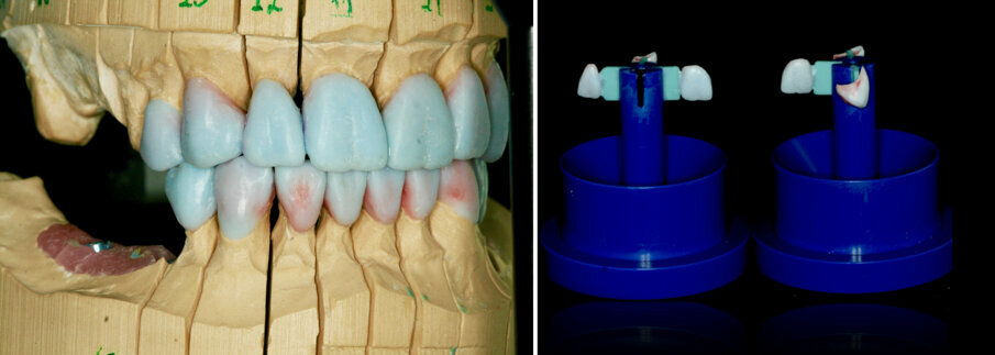 Figs 17A-B: Waxed-up crowns on the model and waxed to the investment ring base.