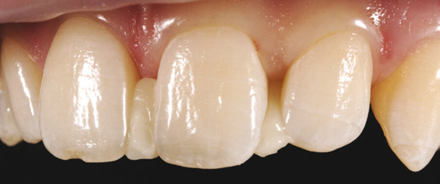3. Ispunjavanje dijastema kompozitom na nejetkanim površinama zuba. 
