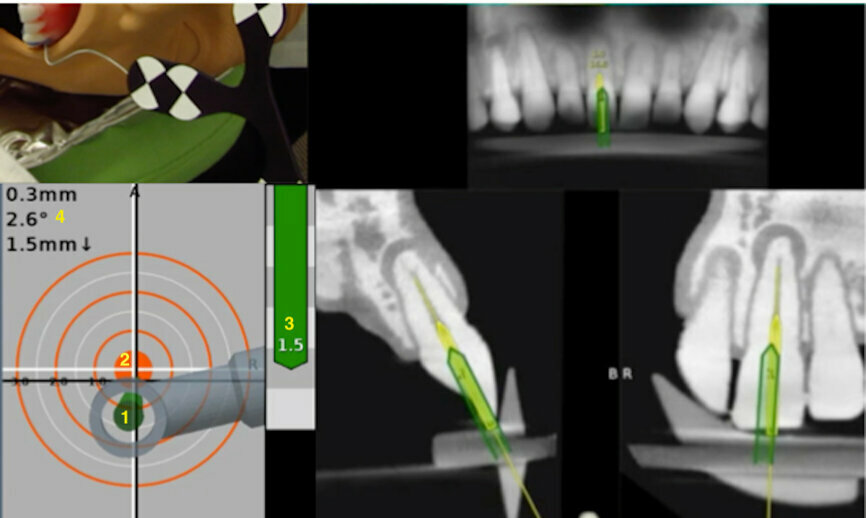 Fig. 9a: Calcified central incisor: (1) the drill is green; (2) the central axis of the glide path or osteotomy; (3) the depth indicator; (4) the angle between the drill and central axis of the planned osteotomy. When the drill and the central axis overlap, the depth indicator turns yellow. (Courtesy of Dr Bobby Nadeau)