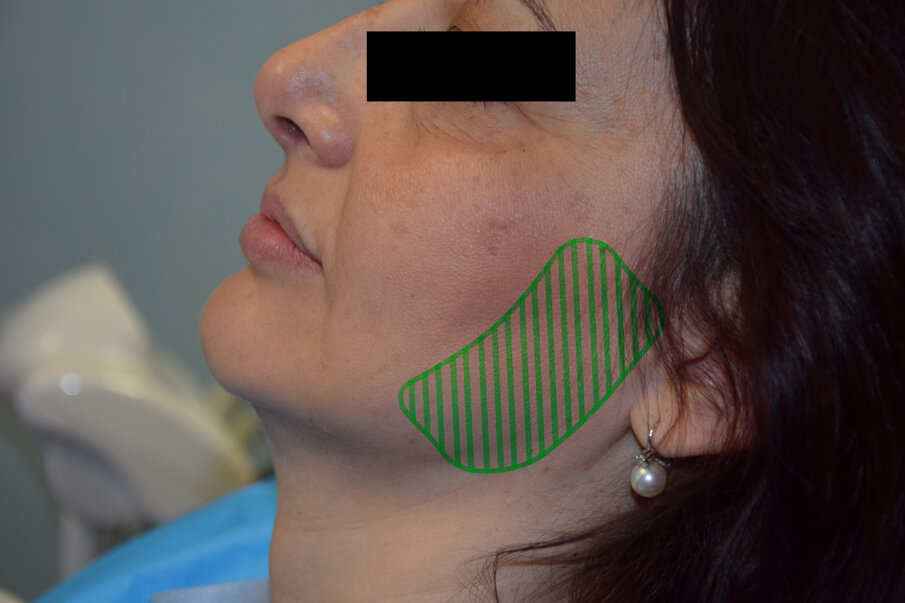 Fig. 3 - Immagine extraorale con evidenziata l’area da sottoporre a irradiazione laser terapeutica.
