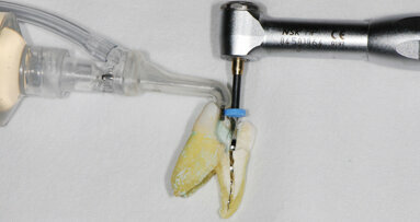 Improving endodontic success through use of the EndoVac irrigation system