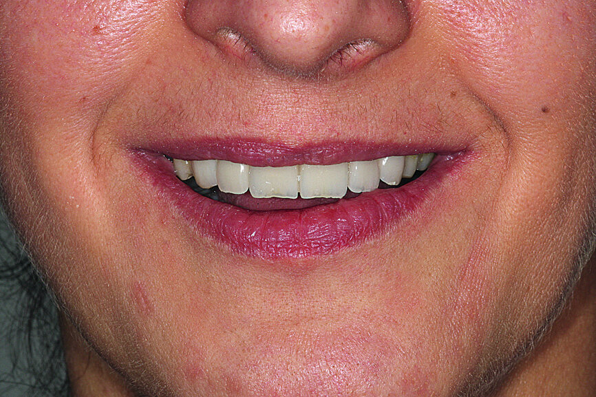 Fig. 30: The patient’s smile showing now well-balanced
incisors in line with the face’s sagittal plane, lip support appearing to be correct.