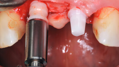 El implante de bredent obtiene el sello de calidad en la EAO