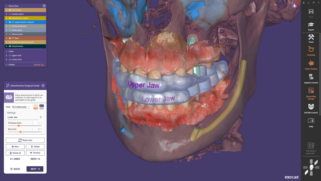 Exoplan 3.1 Rijeka offers a new feature that enables users to simultaneously plan implants and design surgical guides for both jaws.