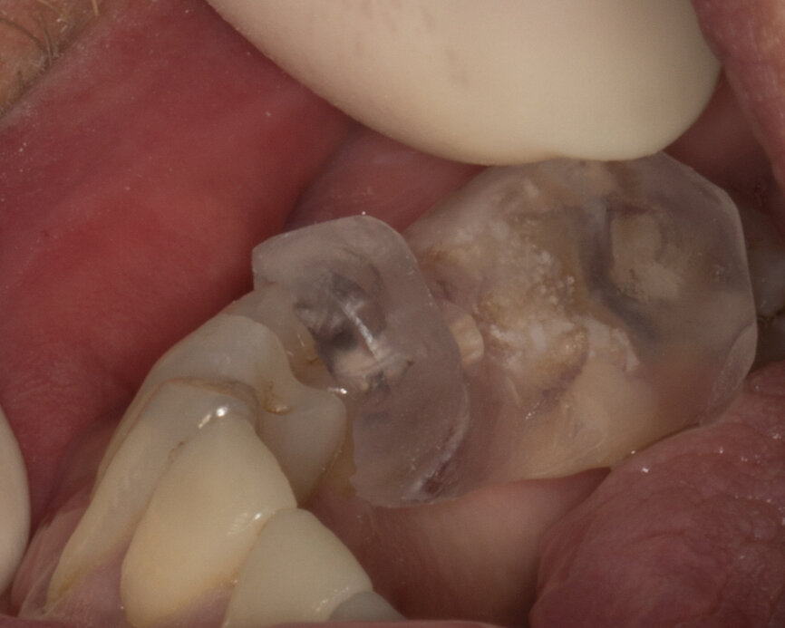 Ryc. 2_Przymiarka szablonu opartego na zębach własnych pacjenta.