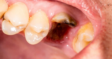Zły stan zdrowia jamy ustnej związany z rakiem wątroby