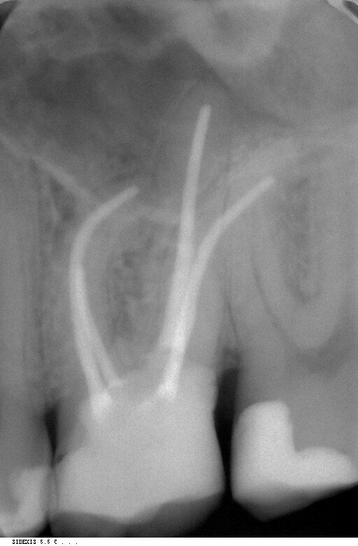 Fig. 6: Final check after root canal filling.