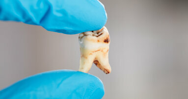 Điều trị kết hợp làm tăng hiệu quả chống màng sinh học và chống sâu răng