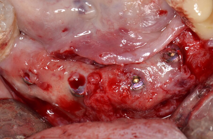 Fig. 13 - Si evidenzia una consistente quota di tessuto neorigenerato e la completa risoluzione dei difetti peri-implantari.