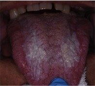 Fig. 1a - Fotografia digitale di paziente con quadro clinico e diagnosi di Lichen Planus Orale.
