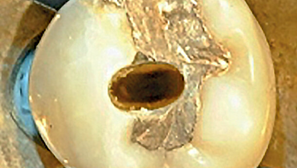 Příprava vstupů do kořenových kanálků – předpoklad úspěšné endodoncie