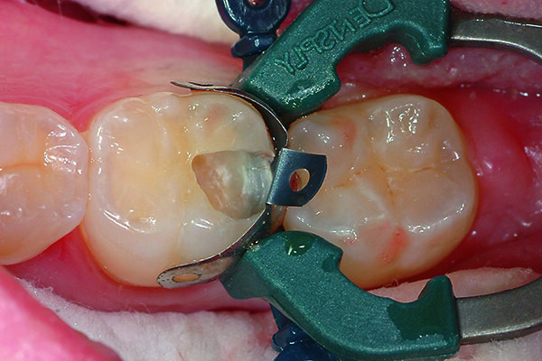 Cavity preparation and the Palodent® V3 system in place.