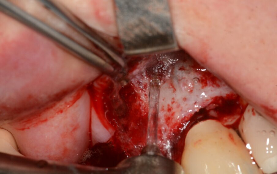 Fig. 16: Granulation tissue removal with Er:YAG.