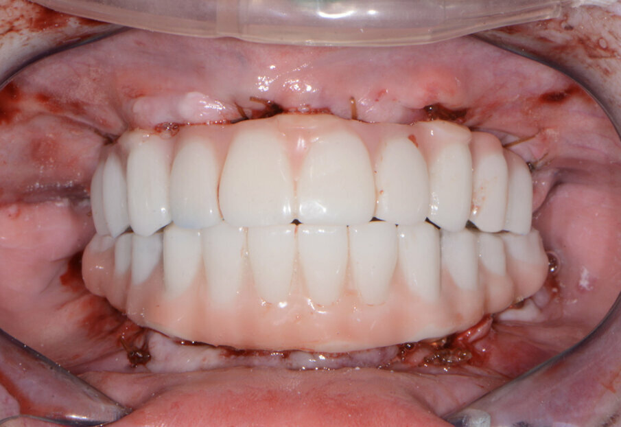 Fig. 15: Maxillary and mandibular provisional restorations.