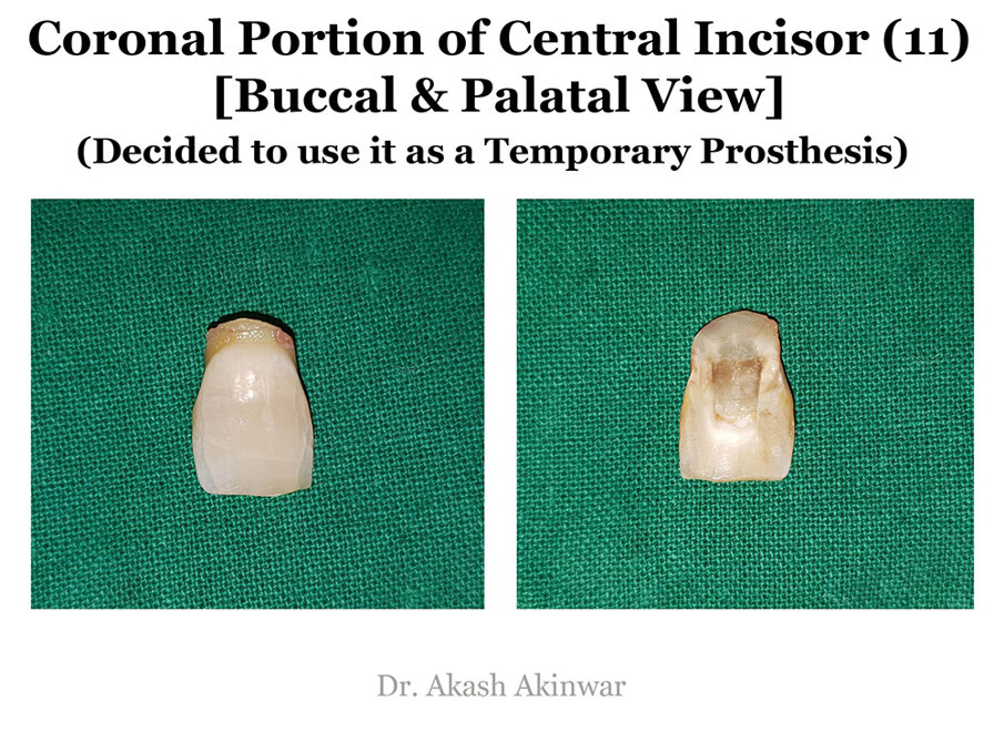 Fig 7: Removal of the mobile crown fragment
