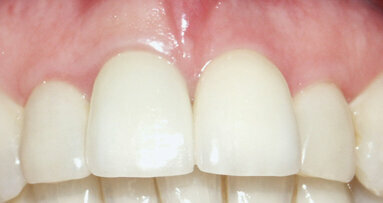 Immediate single-tooth replacement, provisionalization