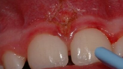 L’utilizzo del laser in ortodonzia
