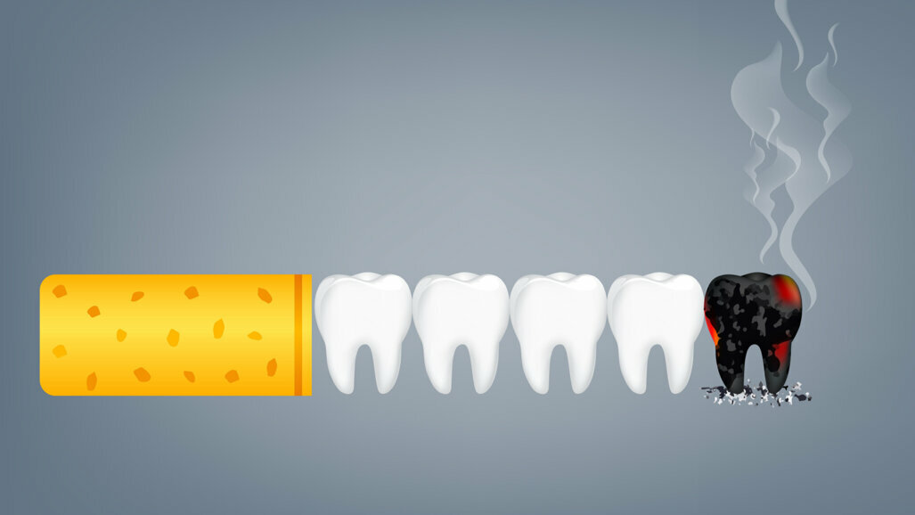 Schadensminderung beim Rauchen – Welche Rolle können Zahnmedizinerinnen und Zahnmediziner einnehmen?