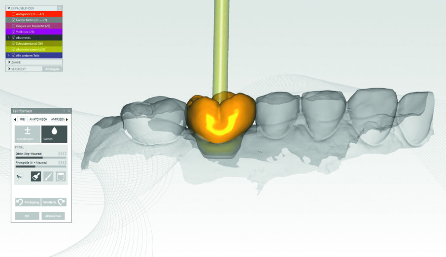 Fig. 10: The titanium-based abutment crown constructed from VITA ENAMIC IS.