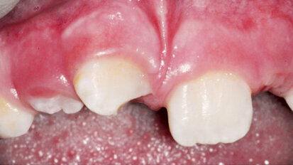 Endodontické ošetření zubů s nedokončeným vývojem kořene