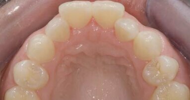 Inmam Aligner: Korigovanje položaja zuba, beljenje i izrada direktnih adhezivnih restauracija – progresivni pristup preoblikovanju izgleda osmeha (Drugi deo)