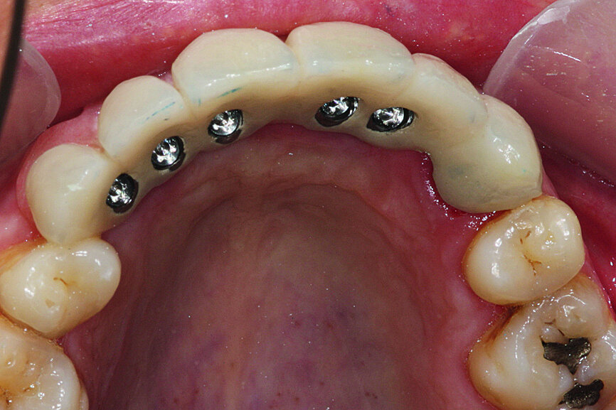 Fig. 29: The prosthesis was attached with screws and the necessary occlusal verification was conducted.