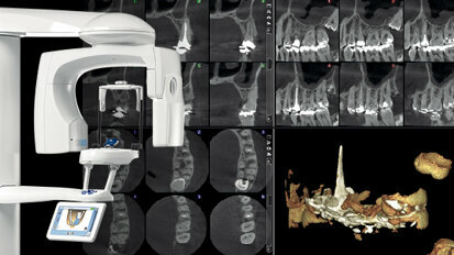 Novo modo de radiologia endodôntica da Planmeca – imagens detalhadas sem ruído ou artefactos