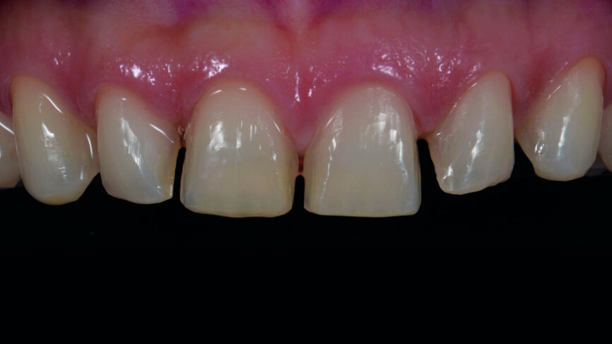 Fig. 9c: Final preparation of the teeth.