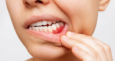 Il trattamento parodontale risulta inefficace nei forti fumatori con parodontite grave