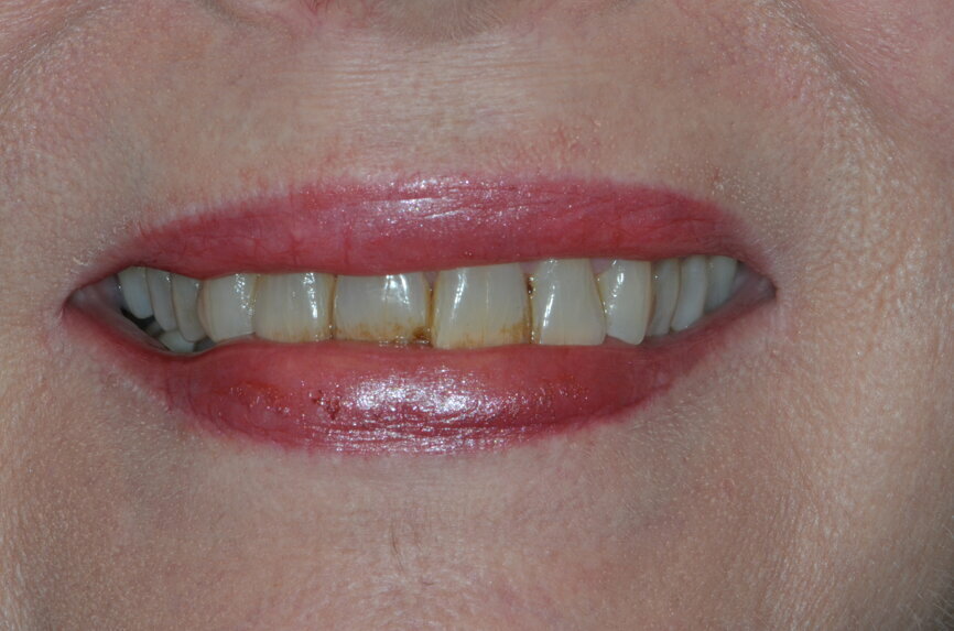 Fig. 12: Preoperative smile photograph.