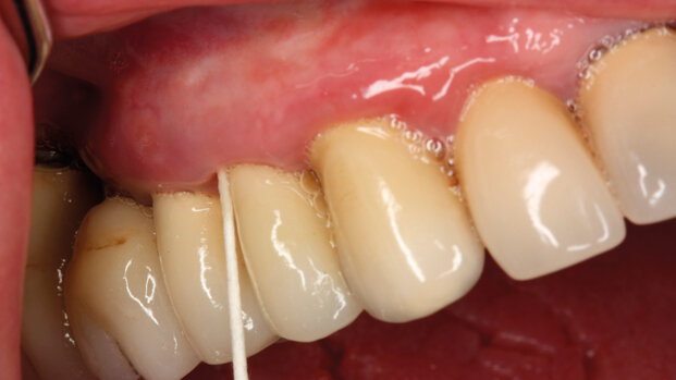 Modificazioni della flora microbica orale  dopo attuazione di un piano di trattamento implanto-protesico