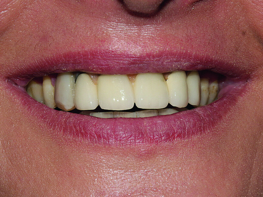 Fig. 2 : Initial prostheses: Lip support was ensured by a large false gingiva, and fractured cosmetic material at the right maxillary canine was evident. The patient’s smile showed the prosthetic teeth placed off-centre and an infiltration at the right lateral incisal level.