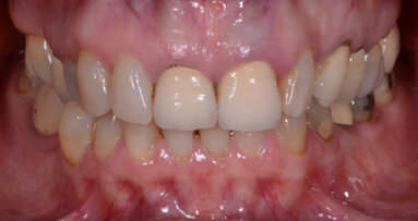 Restoring multiple teeth with a single multilayer zirconia