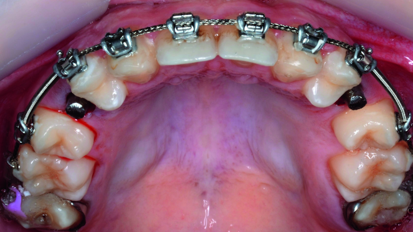 Orthodontic management of maxillary lateral incisors agenesis