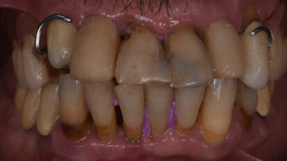 Risoluzione di un caso di parodontite aggressiva con preservazione crestale e chirurgia guidata
