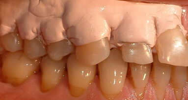 L’applicazione dell’impacco parodontale nel trattamento parodontale non chirurgico