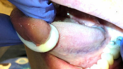 Oral Cancer Screening: “It’s More Than Grasping the Tongue”