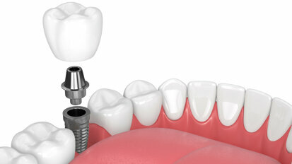 Implant Maintenance for Long Term Success