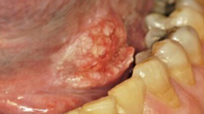 Oral Mucosal Premalignant Diseases and Squamous Cell Carcinoma